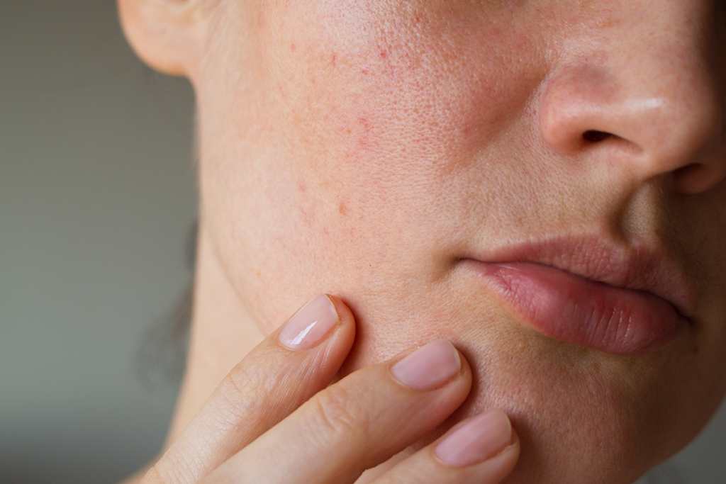 Como maquiar a pele com marcas de acne? Veja aqui as dicas